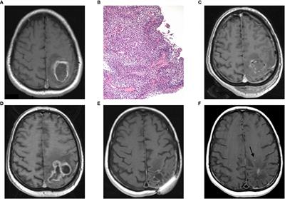 Prolonged survival in patients with local chronic infection after high-grade glioma treatment: Two case reports